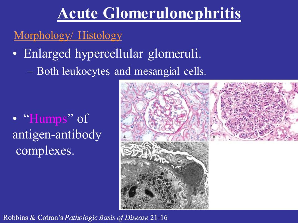 Glomerulonephritis (Bright's Disease)